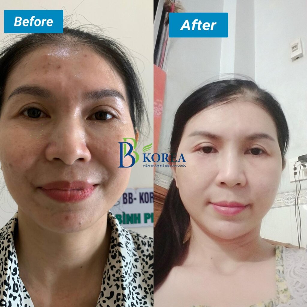 Chị Đào Cấy Mỡ Mặt BaBy Face tại Viện Thẩm Mỹ BBKOREA