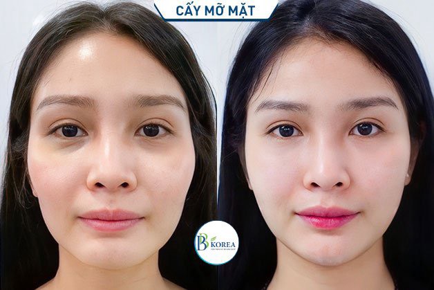 Chị Trà Cấy Mỡ Mặt Baby Face tại BBKOREA