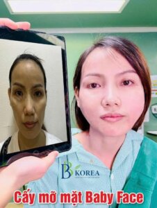 Chị Mai Cấy Mỡ Mặt Baby Face Tại Viện Thẩm Mỹ BBKOREA