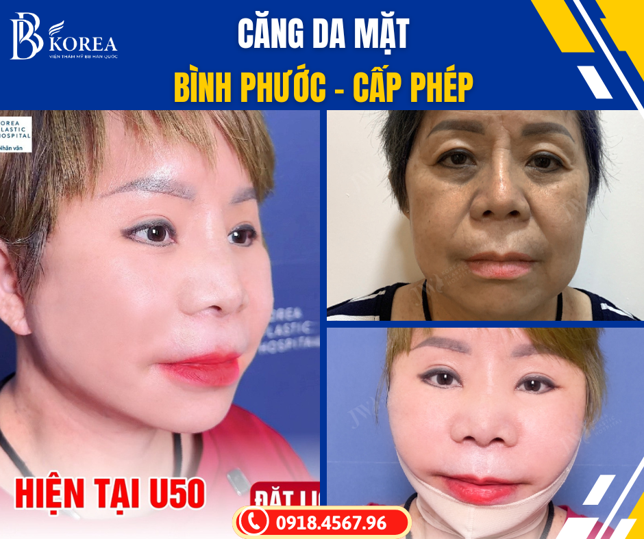 Địa chỉ căng da mặt uy tín Bình Phước