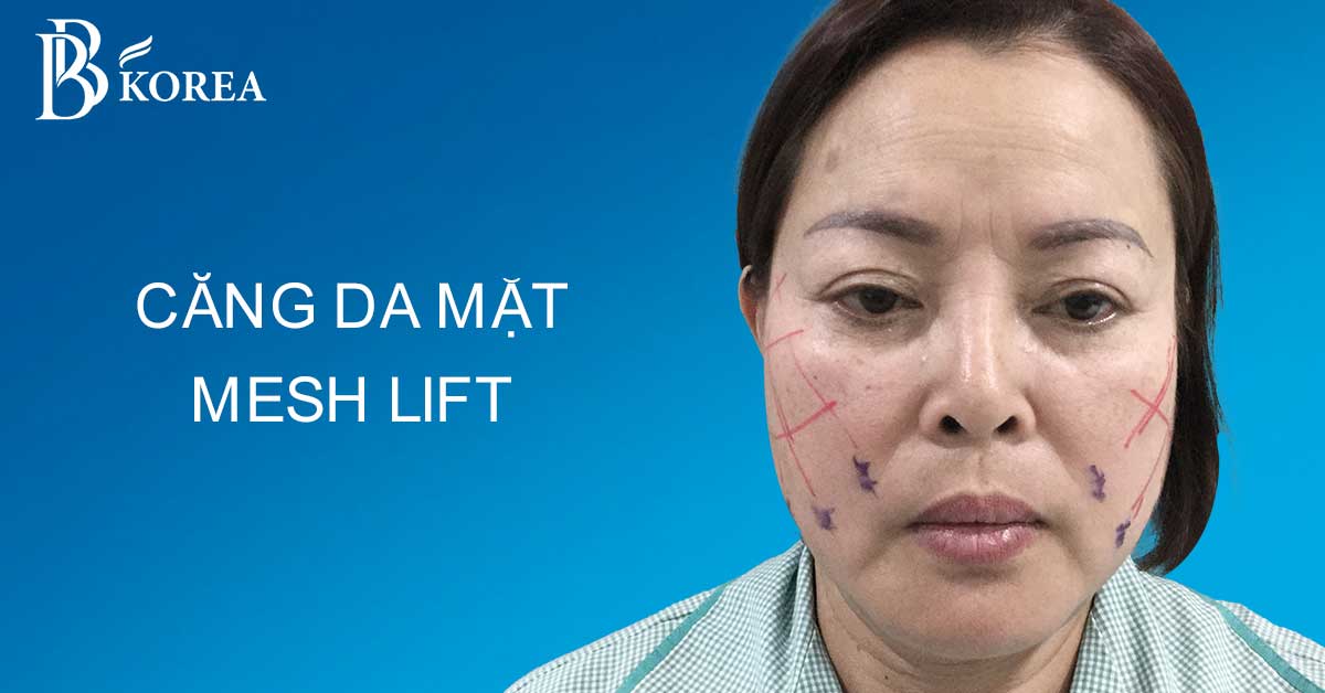 CĂNG DA MẶT MESH LIFT GIẢI PHÁP TRẺ HÓA DA TOÀN DIỆN