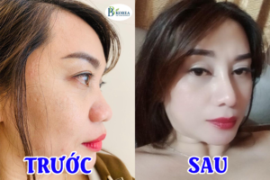 Khách Hàng phẫu thuật mũi Sline Tại Viện Thẩm Mỹ BBKOREA