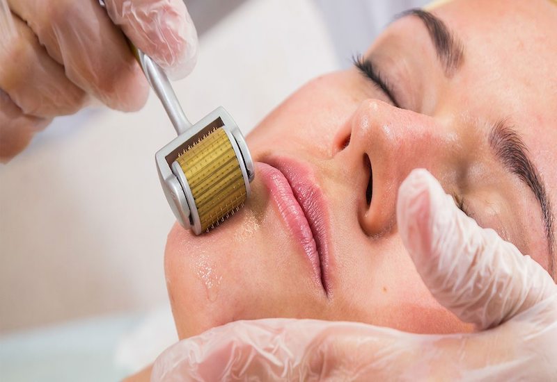 Điều trị sẹo rỗ Giải pháp hiệu quả cho làn da hoàn hảo