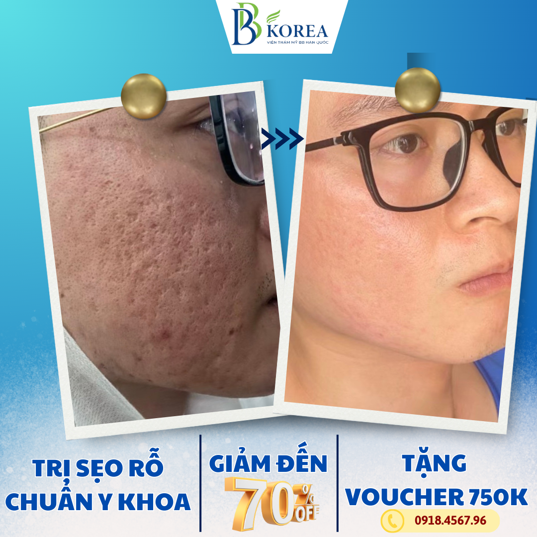 Khách hàng trị Sẹo Rỗ tại Viện Thẩm Mỹ BBKOREA