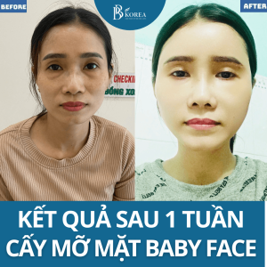 "Hiệu quả sau 1 lần cấy mỡ mặt baby face Đồng Xoài – khách hàng tại BB KOREA"