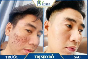 “spa trị mụn uy tín Đồng Xoài Bình Phước