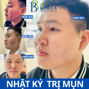 Spa trị mụn uy tín tại Đồng Xoài Bình Phước – BB KOREA