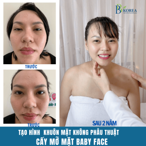 "Khách hàng sau cấy mỡ mặt baby face Đồng Xoài tại BB KOREA"