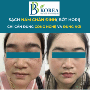 điều trị nám chân đinh tại BB KOREA Đồng Xoài Bình Phước