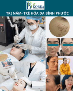kết quả trị nám tại BB KOREA Đồng Xoài Bình Phước