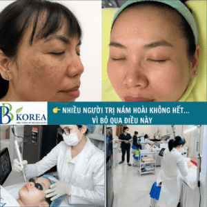 Khách hàng cải thiện nám sau liệu trình tại BB KOREA