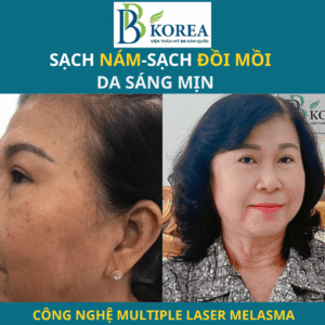 trị nám Đồng Xoài Bình Phước tại BB KOREA – trước và sau điều trị nám