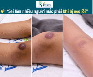ĐIỀU TRỊ SẸO ĐÚNG PHÁC ĐỒ giúp hạn chế tăng sinh mô sẹo thêm