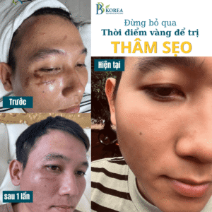 sẹo lồi Đồng Xoài Bình Phước tại BB KOREA