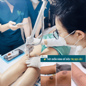 MULTIPLE LASER Hỗ trợ cải thiện sẹo chuẩn y khoa 
