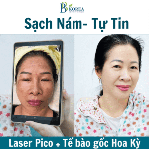 Kết quả điều trị nám da công nghệ cao tại BB KOREA Bình Phước
