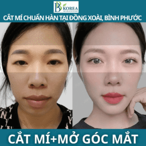 Nhấn mí hay cắt mí Bình Phước