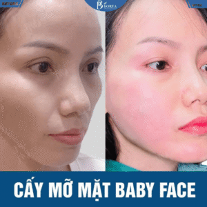 Cấy mỡ mặt Baby Face tại BB KOREA Đồng Xoài, Đồng Nai