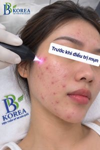 Trị mụn Plasma lạnh Đồng Xoài Bình Phước