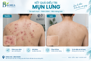 Kết quả cải thiện mụn lưng nam