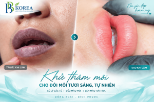 Khử thâm môi tại Đồng Xoài – Bình Phước giúp cải thiện nền môi xỉn màu, hướng đến sắc môi tươi và hài hòa hơn.