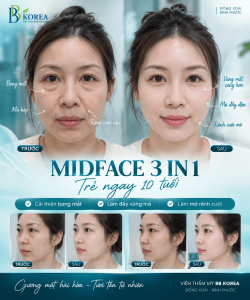 Midface là vùng giữa khuôn mặt, liên quan đến vùng dưới mắt, má và rãnh mũi – má.