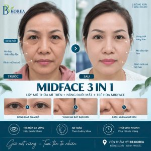 Bọng mắt và rãnh cười rõ cần được đánh giá trong tổng thể vùng giữa khuôn mặt.