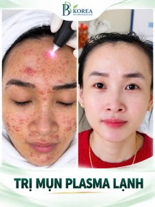 Kết quả trước và sau chăm sóc da mụn Plasma lạnh BB KOREA Đồng Xoài Bình Phước