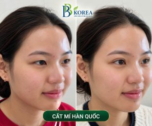Hình ảnh giới thiệu ưu đãi dịch vụ nâng mũi Hàn Quốc và cắt mí Hàn Quốc tại BB KOREA, TP. Đồng Xoài, tỉnh Bình Phước.