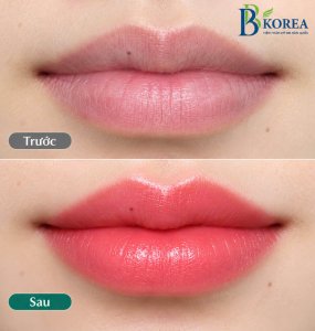 Hình ảnh thực tế trước và sau khi phun môi tại Viện Thẩm Mỹ BB KOREA. Kết quả lên màu có thể khác nhau tùy thuộc vào nền môi, cơ địa và quá trình chăm sóc.