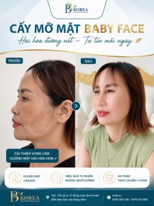 Kết quả trước và sau cấy mỡ mặt Baby Face tại Đồng Xoài, Bình Phước. Hình ảnh minh họa sự thay đổi vùng má hóp, thái dương lõm và đường nét khuôn mặt sau thực hiện.