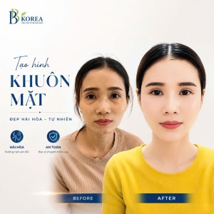 Cấy mỡ mặt Đồng Xoài, Bình Phước – thông tin về phương pháp làm đầy vùng mặt tại BB KOREA.