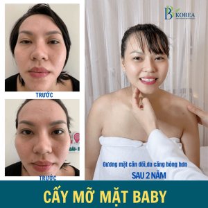 Tìm hiểu dịch vụ Baby Face và các phương pháp làm đầy vùng mặt tại BB KOREA.