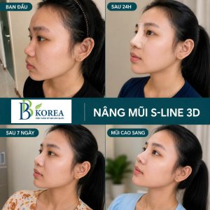 Thông tin về dáng mũi S-line Hàn Quốc dành cho người tìm hiểu dịch vụ nâng mũi Đồng Xoài.