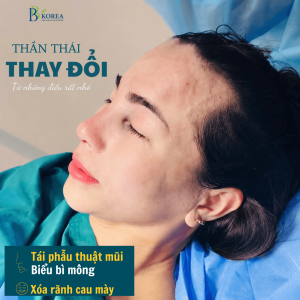 Tìm hiểu tái phẫu thuật mũi bằng trung bì mỡ, các trường hợp có thể cân nhắc và những lưu ý cần biết khi chỉnh sửa mũi tại Đồng Xoài, Bình Phước.
